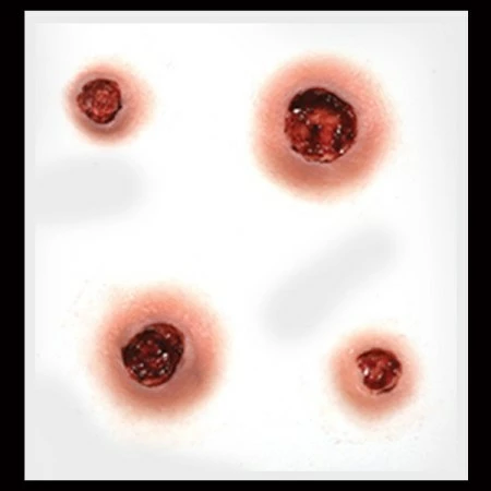 Tinsley Transfers Prosthetics Capped 4 Tinsley Transfers Prosthetics Capped