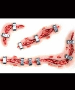 Tinsley Transfers Staplestein Prosthetics